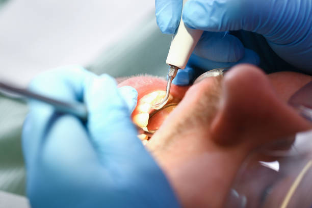 Best Emergency Dentist for Knocked-Out Tooth in Central Islip, NY
